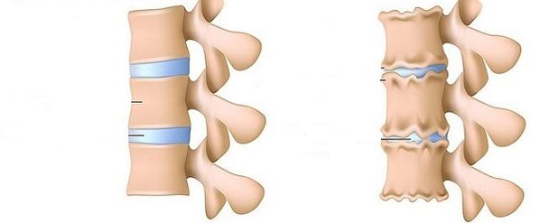 healthy spine and osteochondrosis