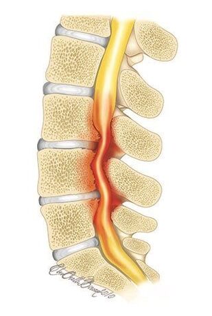 In osteochondrosis of the thoracic spine, compression of the spinal canal occurs