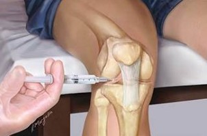 Injections of hyaluronic acid
