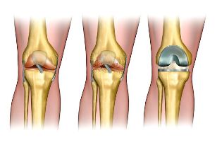 the degree of osteoarthritis