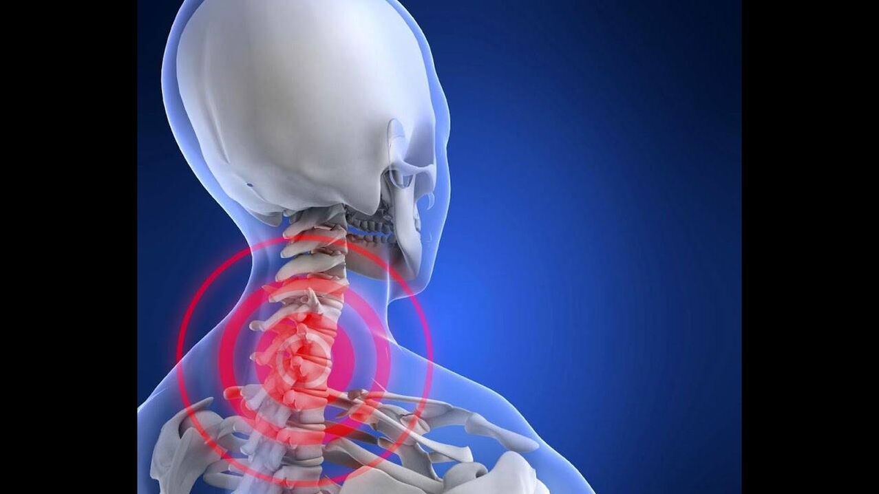 Osteochondrosis Bay of spine