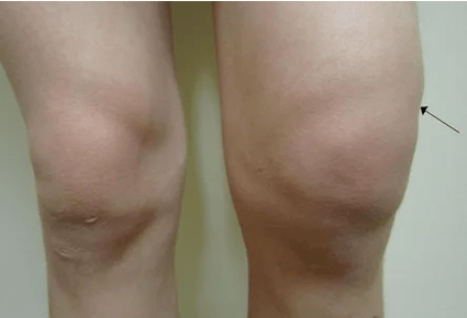 Head of the knee wrist