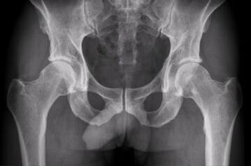 Diagnostic options for hip joint arthrosis