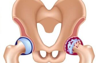 Phases of the development of the hip joint arthrosis