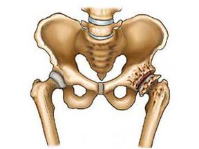 What is the Arthrosis of the hip joint