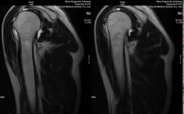 x-ray for the diagnosis of shoulder arthrosis
